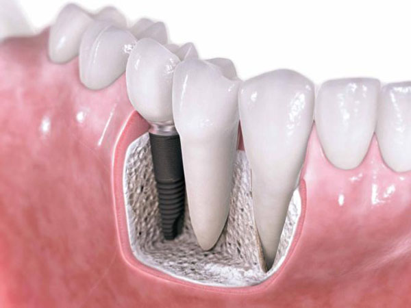 شدت درد پیوند استخوان برای ایمپلنت دندان