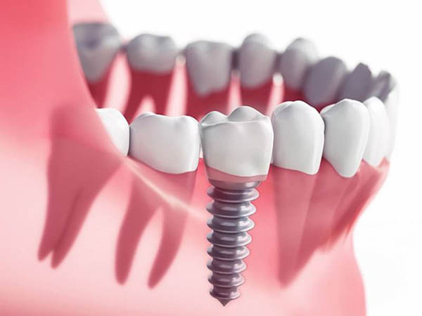 مزایای ایمپلنت فوری دندان