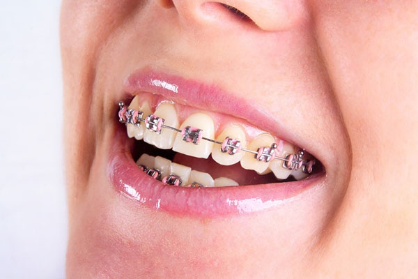مراقبت از دندان های ارتودنسی