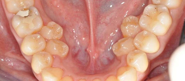 جراحی دندان اضافه پشت دندان شیری در کودکان