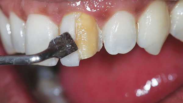 شرایط لازم برای کامپوزیت کردن یک دندان
