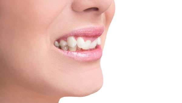 درمان دندان نیش بیرون زده بدون ارتودنسی