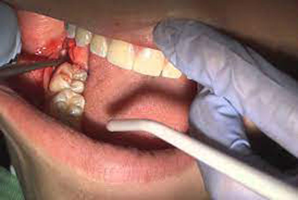 عمل بینی و جراحی دندان عقل