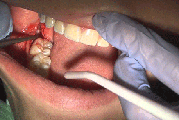 بدن درد بعد از کشیدن دندان عقل