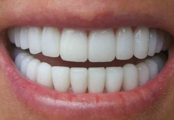 زیبایی و لبخند با ایمپلنت دندان