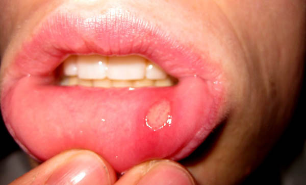 آفت دهان بعد از عمل بینی