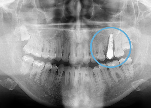 تأثیرات مخرب قلیان بر ایمپلنت دندان