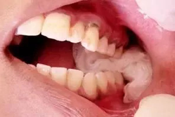 خونریزی بعد از کشیدن دندان