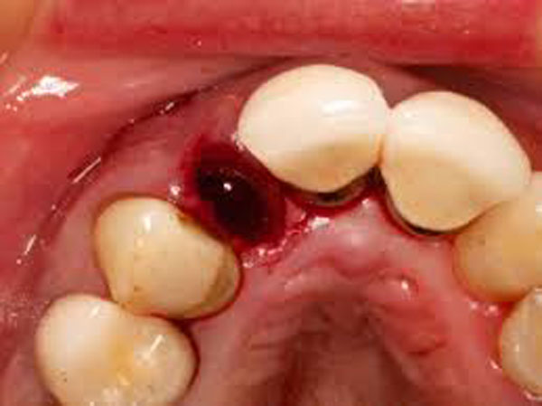 خونریزی بعد از کشیدن دندان تا چند ساعت