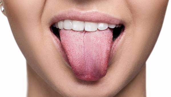 برای قارچ دهان و زخم زبان به چه دکتری مراجعه کنیم