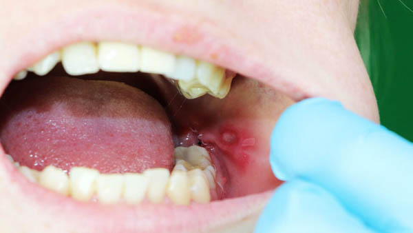 دلایل آفت دهان بعد از جراحی دندان