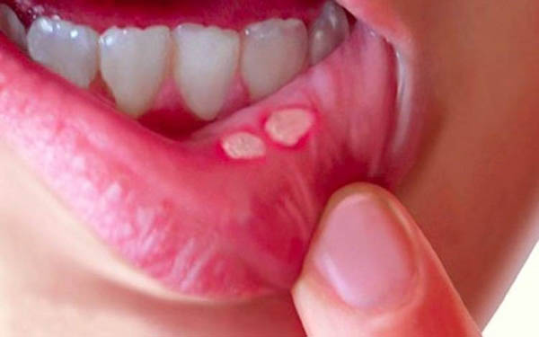آفت دهان بعد از جراحی دندان