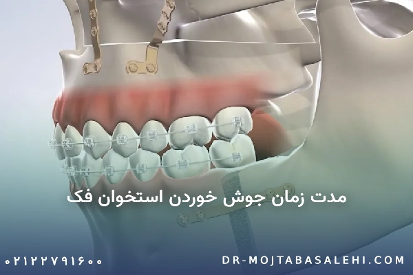 مدت زمان جوش خوردن استخوان فک