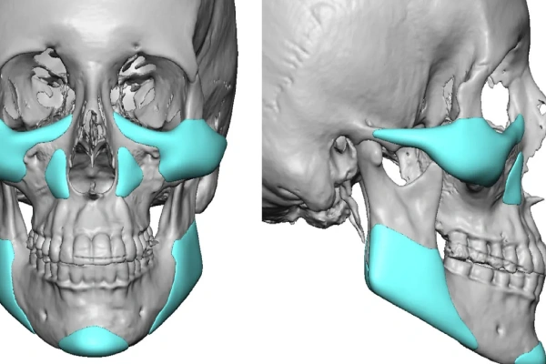 شکستگی گونه