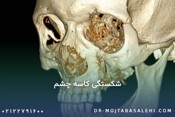 شکستگی کاسه چشم