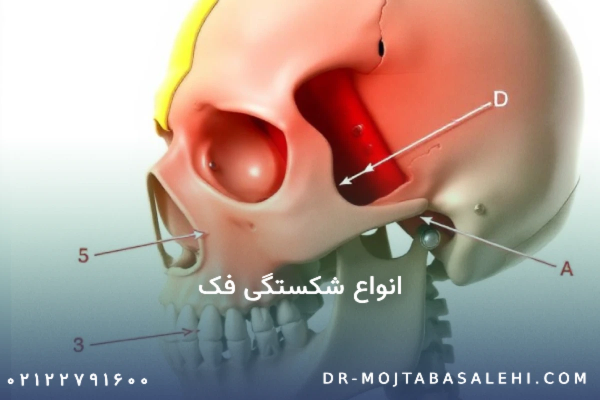انواع شکستگی فک