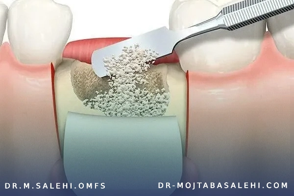 الوئولوپلاستی فک