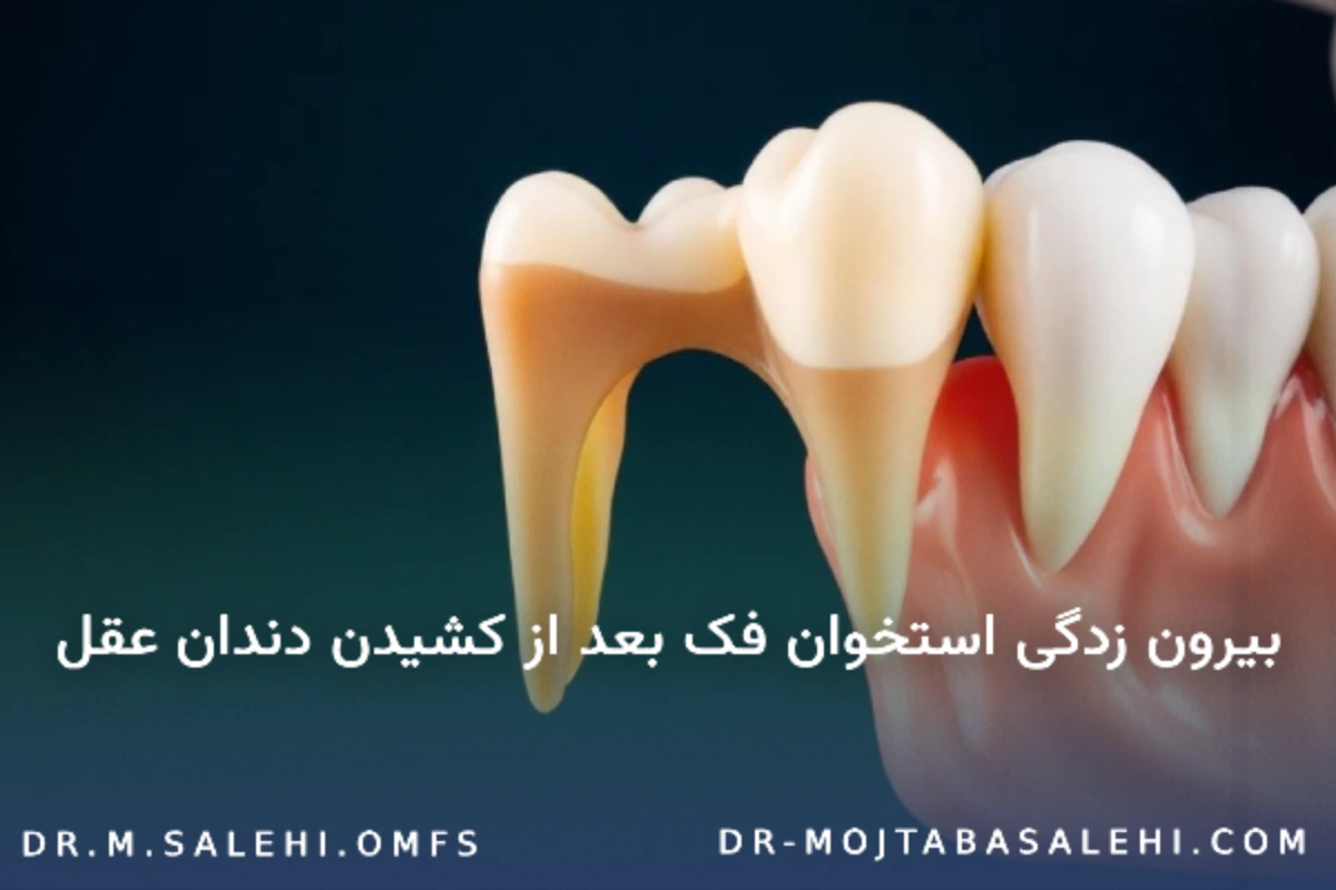 بیرون زدگی استخوان فک بعد از کشیدن دندان عقل