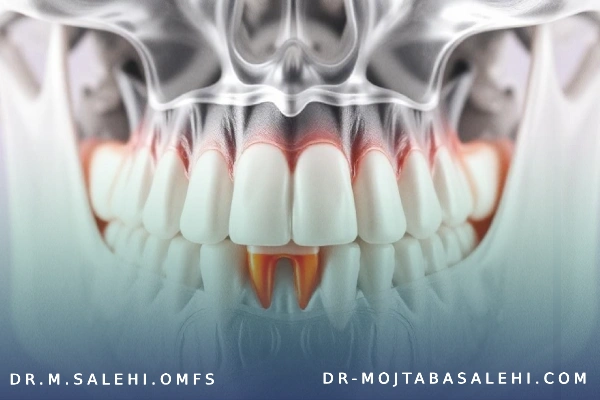 بیرون زدگی استخوان فک بعد از کشیدن دندان عقل