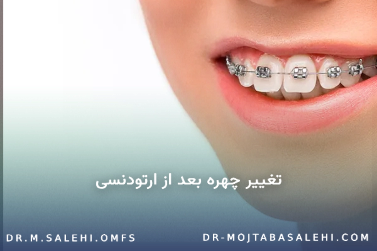 تغییر چهره بعد از ارتودنسی