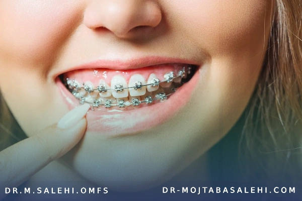 تغییر چهره بعد از ارتودنسی